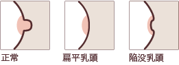 【乳房イラスト：正常・扁平乳頭・陥没乳頭】