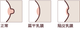 【乳房イラスト:正常・扁平乳頭・陥没乳頭】